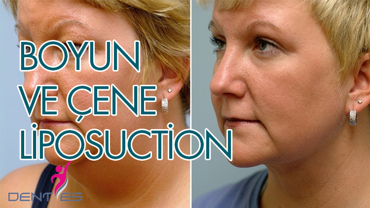 boyun-ve-cene-liposuction-2